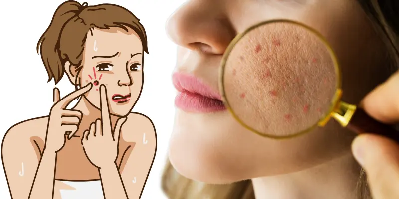 Acne Prone Scarred Skin