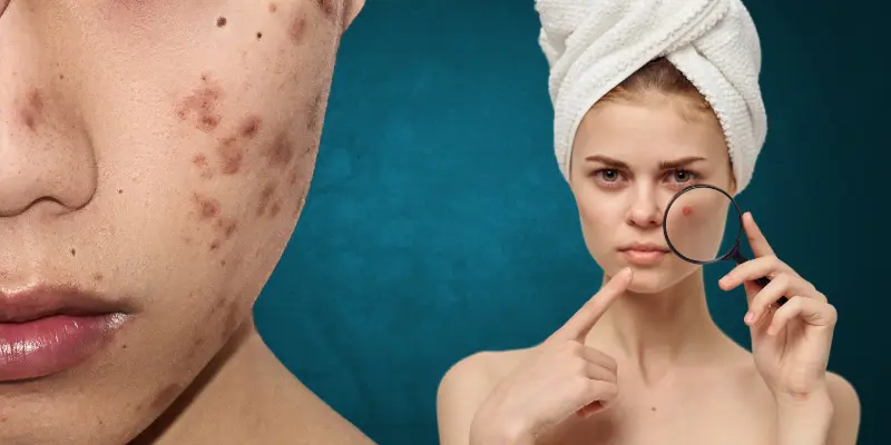 Comprehensive guide to blemished Skincare