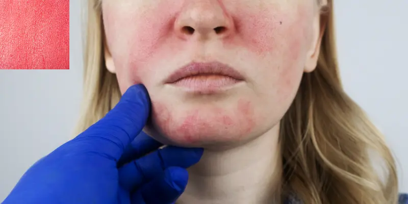 Face Redness