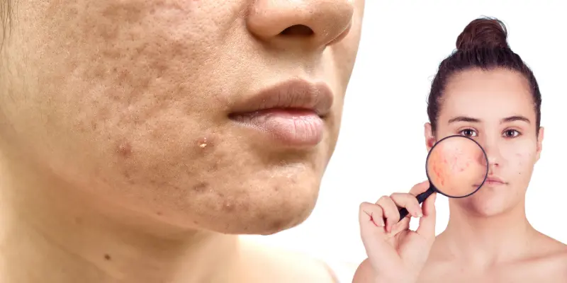 Korean Skincare for Skin Break