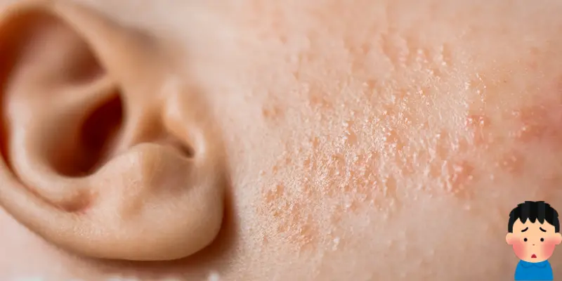 Redness on Cheeks